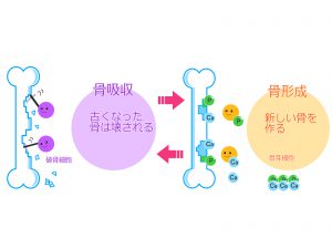 骨粗鬆症
